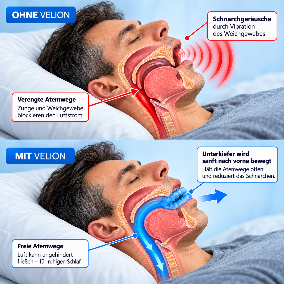 Vergleich der Atemwege vor und mit Velion SleepGuard